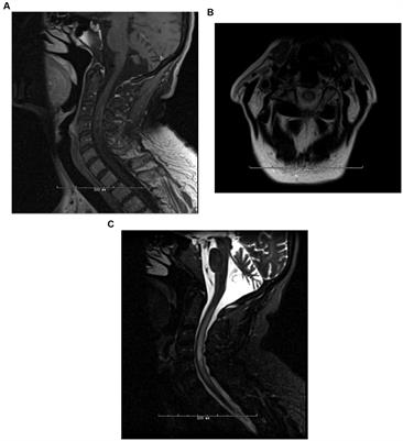 Case report: Transition from anti-CD20 therapy to inebilizumab for 14 cases of neuromyelitis optica spectrum disorder